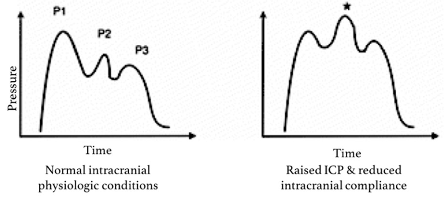 ICP waveform